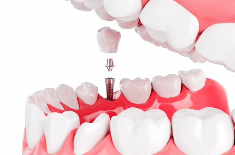Izmir implant tedavisi