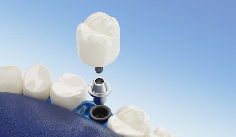 Izmir implant uygulamasi 768x447